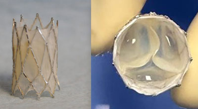 The Iris Valve, a transcatheter, growth-accommodating pulmonary valve designed for very young children, was developed at UC Irvine and is currently progressing toward FDA clinical approval. Arash Kheradvar
